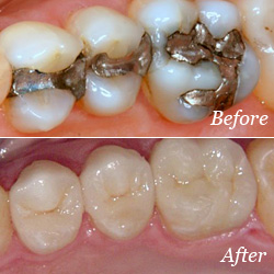 Dental Crowns