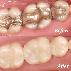 Dental Cavity Filling