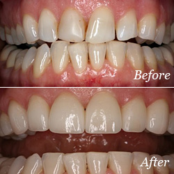 Veneer Treatment