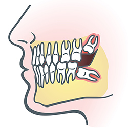 Wisdom Teeth Extraction